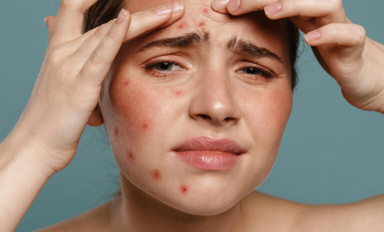 Mulher com sinais de acne inflamatória no rosto buscando solução para pele oleosa e manchas.
